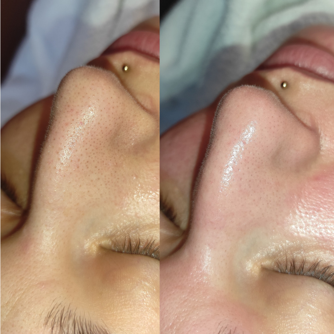 Meliora #zagreb Tretman lica READY TO GLOW